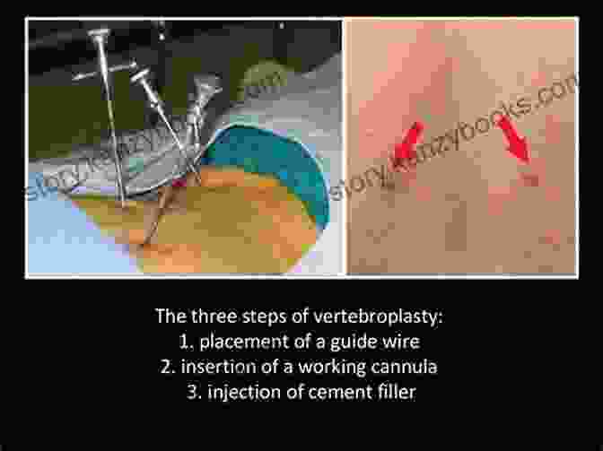 Percutaneous Vertebroplasty And Kyphoplasty Are Minimally Invasive Procedures That Are Used To Treat Vertebral Fractures. Percutaneous Vertebroplasty And Kyphoplasty Richard Clark