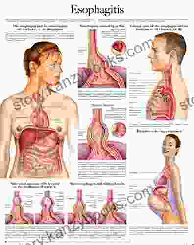 Esophagitis E Chart: Full Illustrated Nadia Q Davies